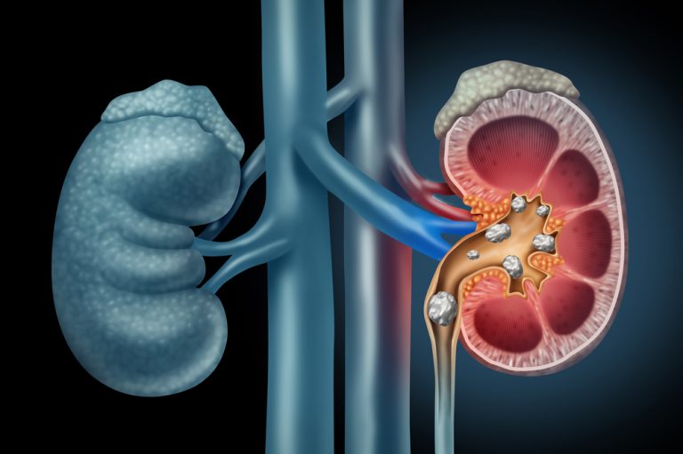 Insuficienta Renala Simptome Cauze Diagnostic Poliana Ro