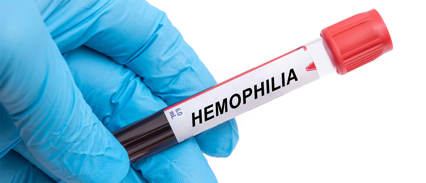 Hemofilie – cauze, simptome si tratament