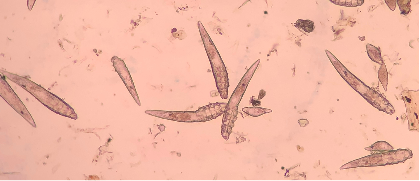 Demodex folliculorum sau acarienii fetei: cauze, simptome si tratament